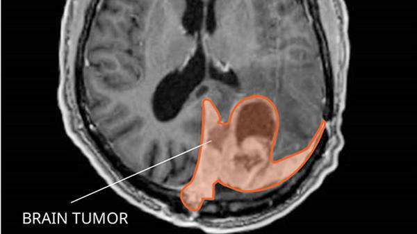Brain Tumor