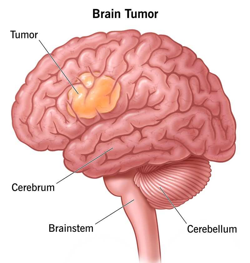 Brain Tumor